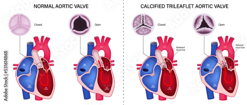 The difference of normal aortic valve and calcified trileaflet aortic valve. Valvular aortic stenosis. Heart anatomy vector. Close-up of normal and abnormal aortic valves. photo