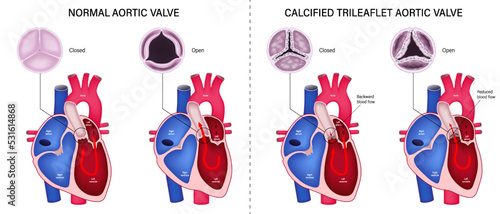 The difference of normal aortic valve and calcified trileaflet aortic valve. Valvular aortic stenosis. Heart anatomy vector. Close-up of normal and abnormal aortic valves.