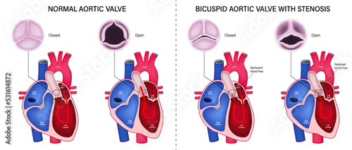 The difference of normal aortic valve and bicuspid aortic valve with stenosis. Valvular aortic stenosis. Heart anatomy vector. Close-up of normal and abnormal aortic valves.
