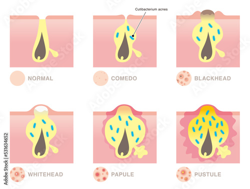Types of acne. Comedo, blackhead, whitehead, papule, pustule. Vector illustration in flat cartoon style isolated on white background. photo