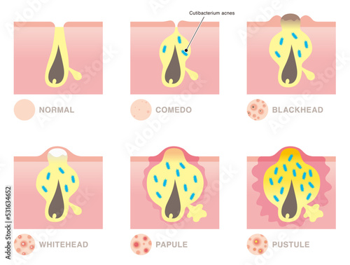 Types of acne. Comedo, blackhead, whitehead, papule, pustule. Vector illustration in flat cartoon style isolated on white background.