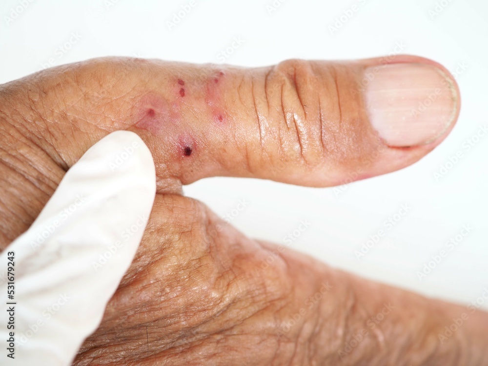 Fototapeta premium Red spots on men's fingers are caused by insect bites. Closeup photo, blurred.