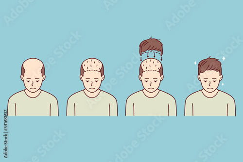 Stages on man hair transplant. Treatment of baldness and alopecia. Set of male patient follicular unit extraction. Vector illustration. 