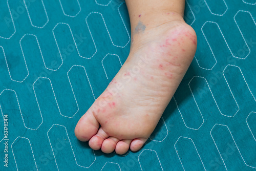 Enterovirus Leg arm mouth Rash on the body of a child Cocksackie virus.Hand foot and mouth disease It is an epidemic in young children and during the rainy season. photo