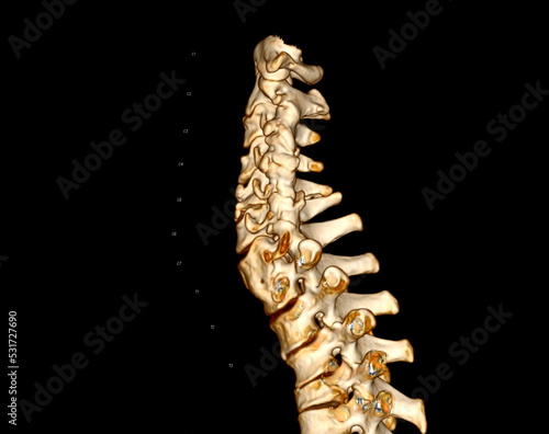 CT SCAN of Cervical Spine ( C-spine ) 3D rendering image .