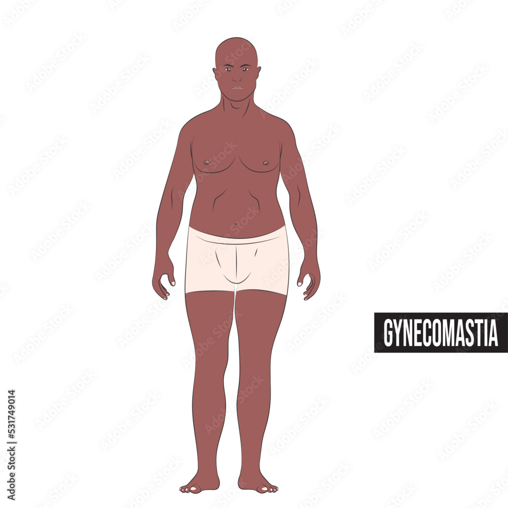 Fototapeta premium Gynecomastia is an increase in the amount of tissue in the mammary glands in boys or men.