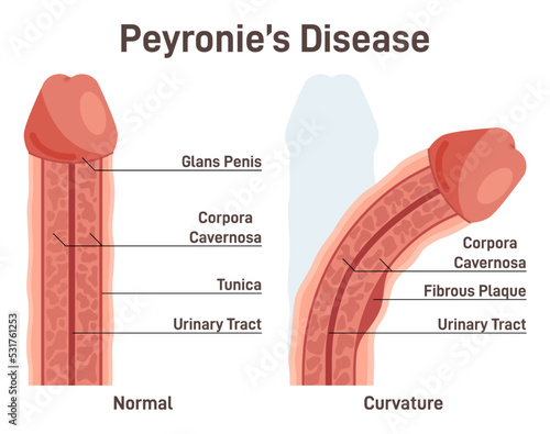 Peyronie's disease. Fibrous scar tissue developing under the skin of the penis