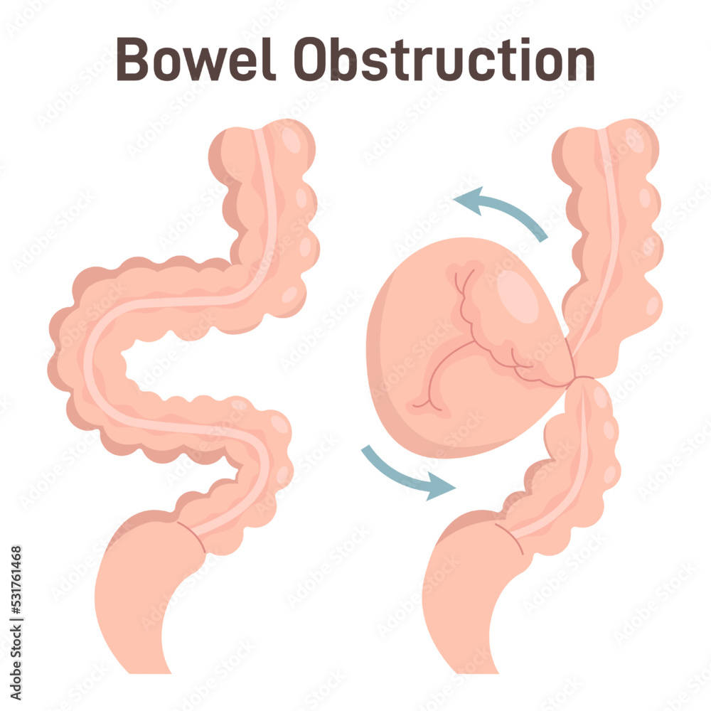Bowel Obstruction Or Volvulus Loop Of Intestine Twists Around Itself bowel-obstruction-or-volvulus-loop-of-intestine-twists-around-itself