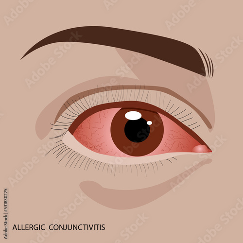 Allergic, conjunctivitis, red eyes, infection and inflammation, close up eye illustration