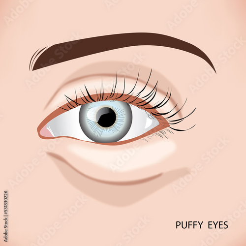 Puffy eye bag close up of aging woman's face, illustration