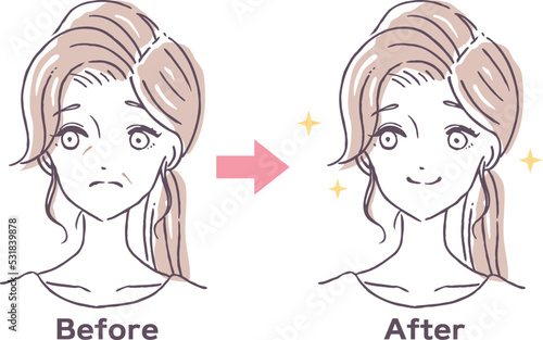 ほうれい線・しわに悩む女性の改善ビフォーアフターイラスト素材