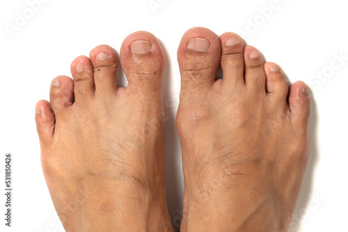 Close up of all the man toes with dry skin and the crack un-even toe nail