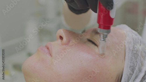 Close-up of a woman face. Needle mesotherapy procedure into the skin of the face photo