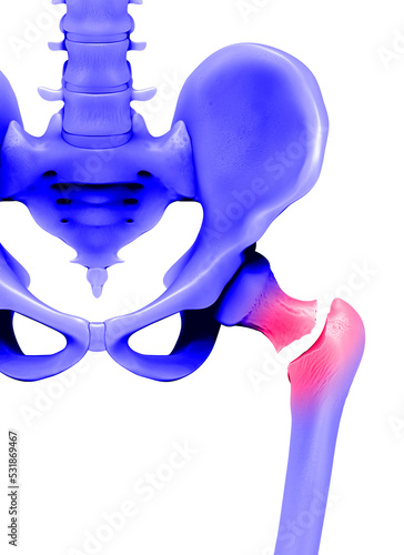 Femure fracture, illustration photo