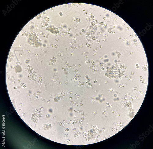 Moderate bacteria and white blood cells in urine.