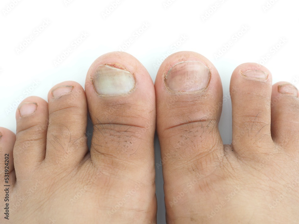 Toenail infection in human. Closeup photo, blurred. Toenail infection in human. Closeup photo, blurred.