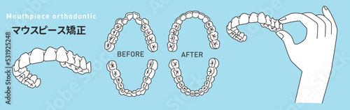 マウスピース矯正/インビザライン/矯正装置/aliner/orthodontic/mouth piece/invisalign