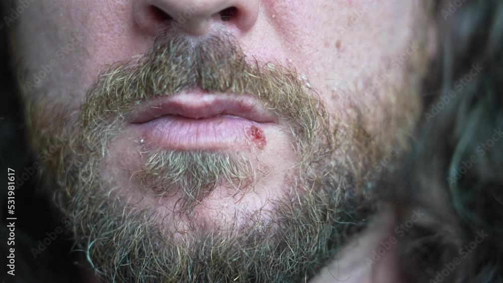 Seborrheic dermatitis and cold sores. Man with long beard shows dry