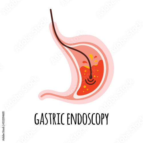 Endoscopy. The stomach of a person with gastritis. Gastroenterology. Vector illustration in a flat style.
