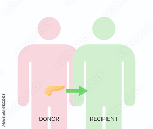 Human organ transplantation concept. Vector illustration of donor and recipient of pancreas organ