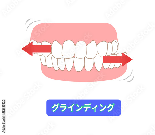 歯ぎしりの種類　クラインディング