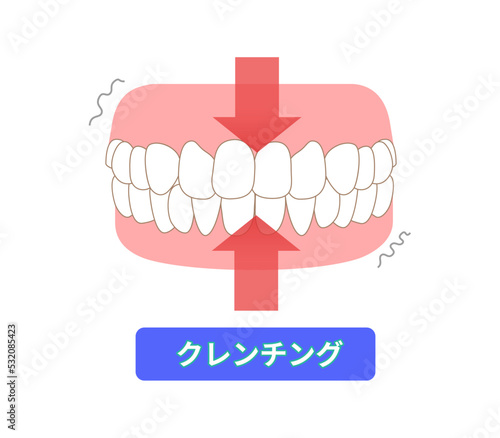 歯ぎしりの種類　クレンチング