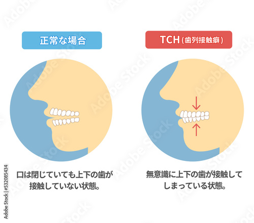 歯の擦り減りとTCH　ストレス顎関節症.