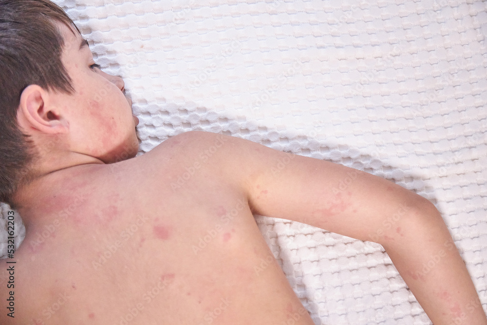 Itchy skin, dermatitis, food allergies. Baby showing her back with acne