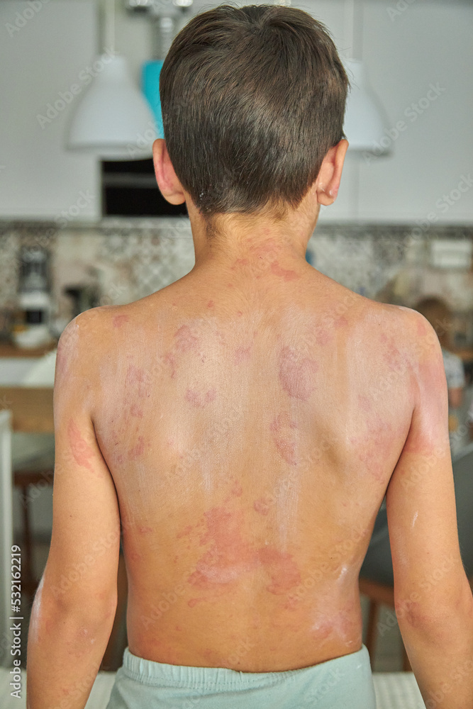 Itchy skin, dermatitis, food allergies. Baby showing her back with acne