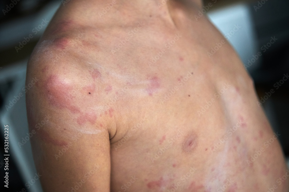 Naklejka premium food allergy. a boy with red spots. The child has itching, with an allergic rash..