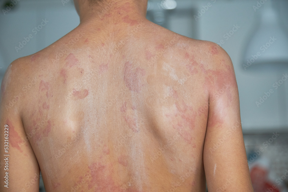 Itchy skin, dermatitis, food allergies. baby showing her back with acne