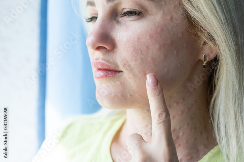 Papules after beauty injections on the face. Closeup photo photo