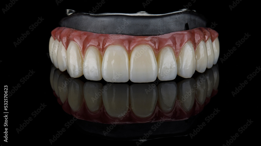 upper jaw prosthesis made of zircon and titanium bar on black background upper jaw prosthesis made of zircon and titanium bar on black background