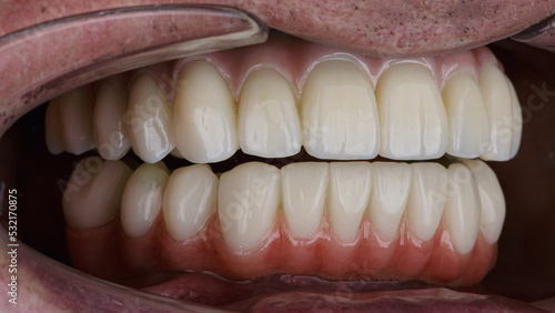 two prostheses in the patient's mouth in the open state