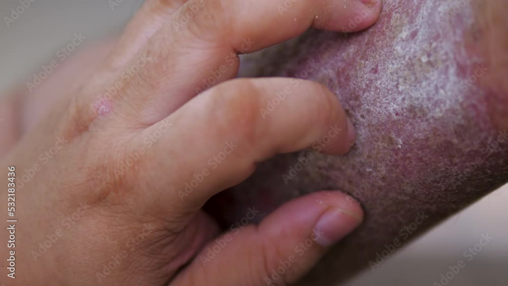 The man is sick with psoriasis relief cream, Medical and health care concept, The man with skin rash The man is sick with psoriasis relief cream, Medical and health care concept, The man with skin rash
