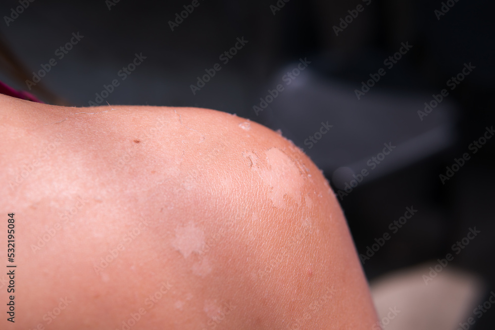 Fototapeta premium Sun tan on skin close up