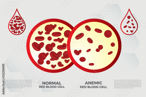 Anemia Iron red blood cell medical vector illustration medical.
