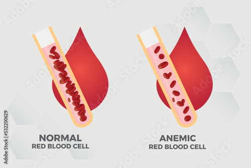 Anemia Iron red blood cell medical vector illustration medical.
