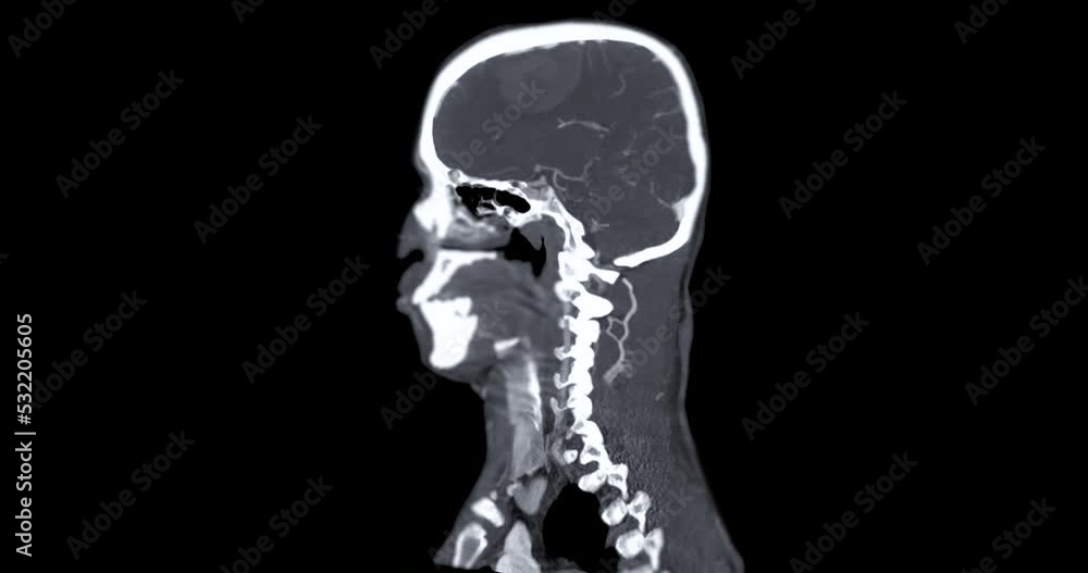 CTA  Brain or Computed tomographic angiography of cerebral artery 2D image for diagnosis cerebral artery aneurysm and stroke diseases
