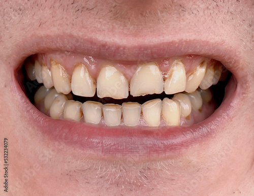 Smiling mouth of man with crooked yellow teeth close-up. Unhealthy worn teeth requiring treatment in dentistry. Bruxism
