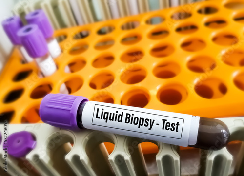 Blood samples for Liquid biopsy blood test to detect cancer cells or DNA fragments that circulate in the bloodstream, Lung cancer, laboratory background.