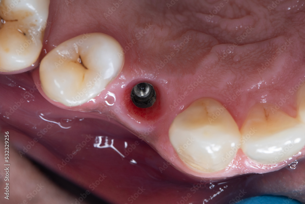 Obraz premium Dental Implant 