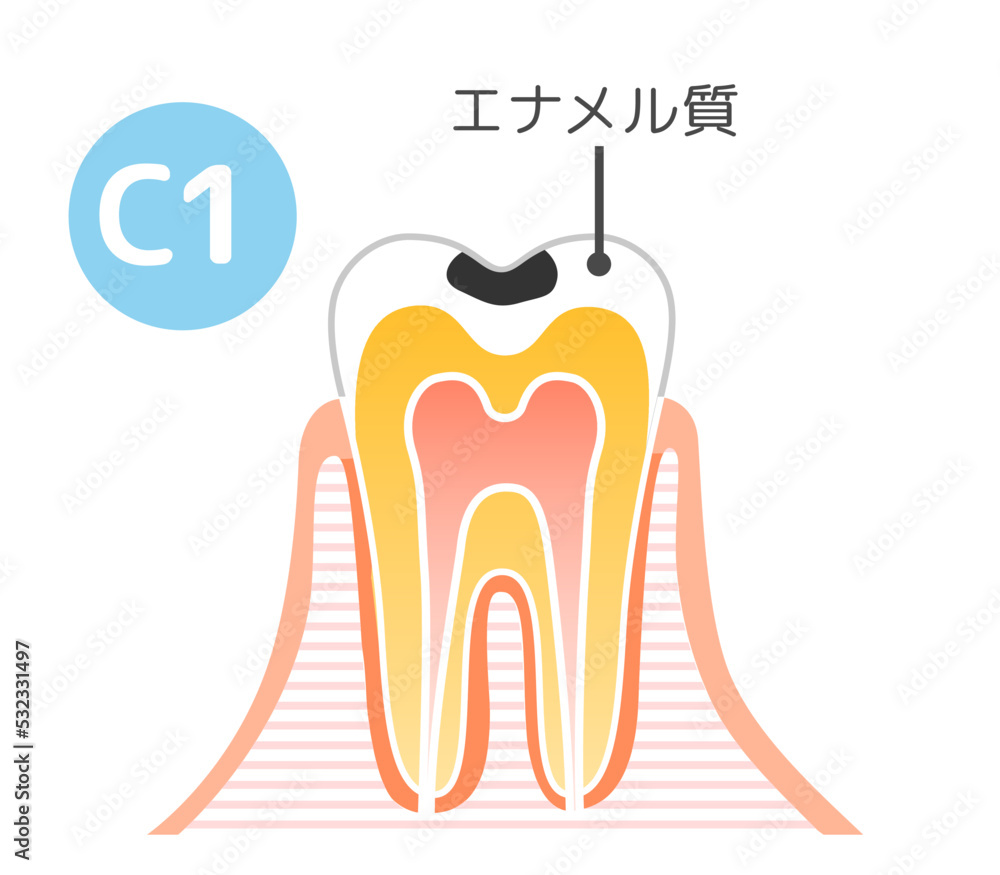 虫歯と進行C1~C4と治療:歯科のイラスト.