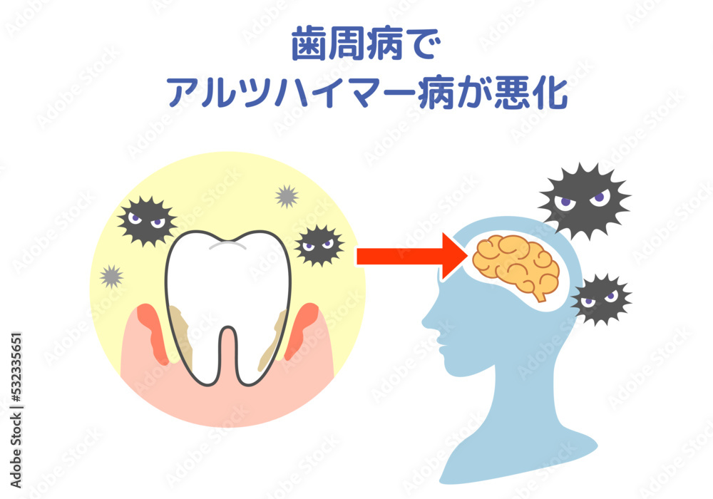 Fototapeta premium 歯周病とアルツハイマー病の関係.