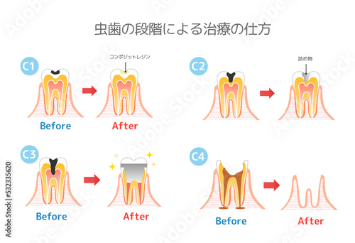 虫歯と進行と治療:歯科のイラスト