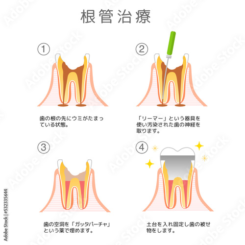 根管治療 虫歯と進行と治療:歯科のイラスト