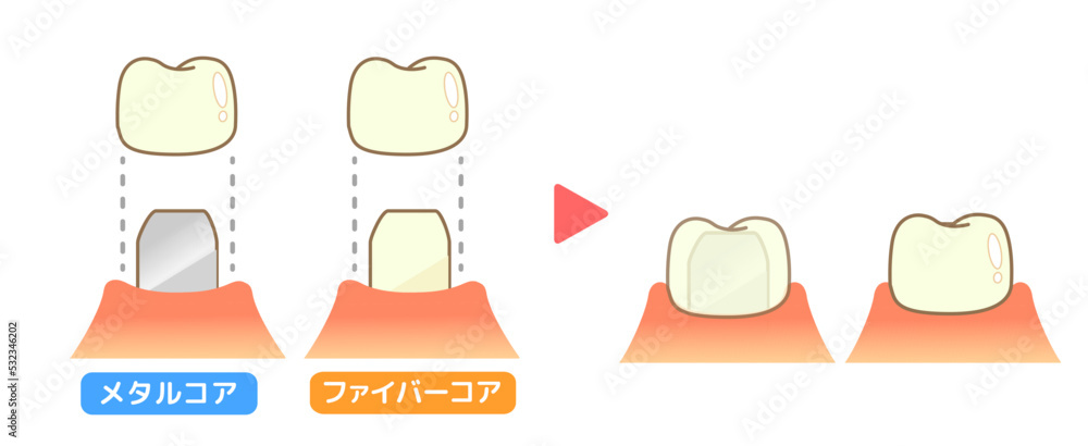クラウン 虫歯と進行と治療:歯科のイラスト. Stock Vector | Adobe Stock