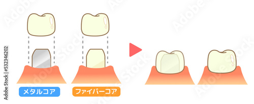 クラウン 虫歯と進行と治療:歯科のイラスト.
