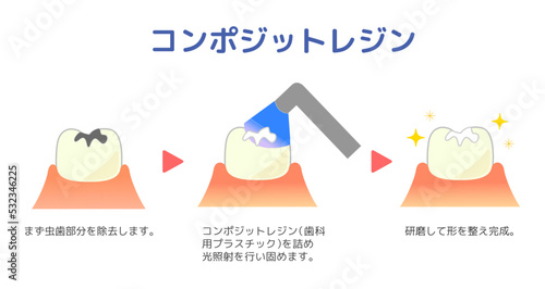 コンポジットレジンCR接着修復法のイラスト.
