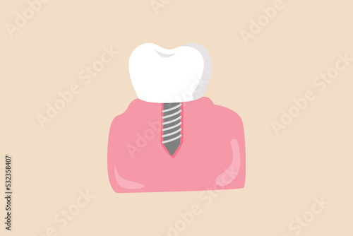 Dental implant. Dentist concept. Colored flat vector illustration.